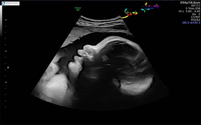 سمێڵی كۆرپەڵە