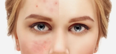 ما سبب ظهور بقع على وجه الصائم في الأيام الأولى من رمضان؟