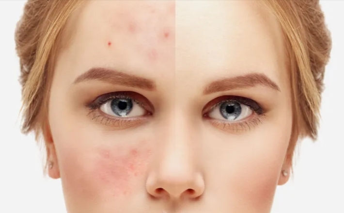 ما سبب ظهور بقع على وجه الصائم في الأيام الأولى من رمضان؟