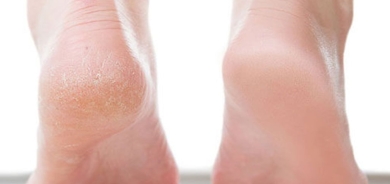 في يومين فقط.. علاج تشقق القدمين بالمكونات الطبيعية