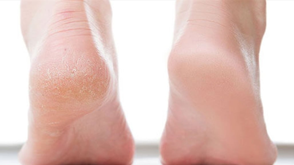 في يومين فقط.. علاج تشقق القدمين بالمكونات الطبيعية