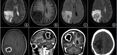 ارتفاع حالات خراج الدماغ لدى الأطفال في الولايات المتحدة