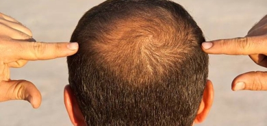 تليين خلايا بصيلات الشعر يعالج الصلع