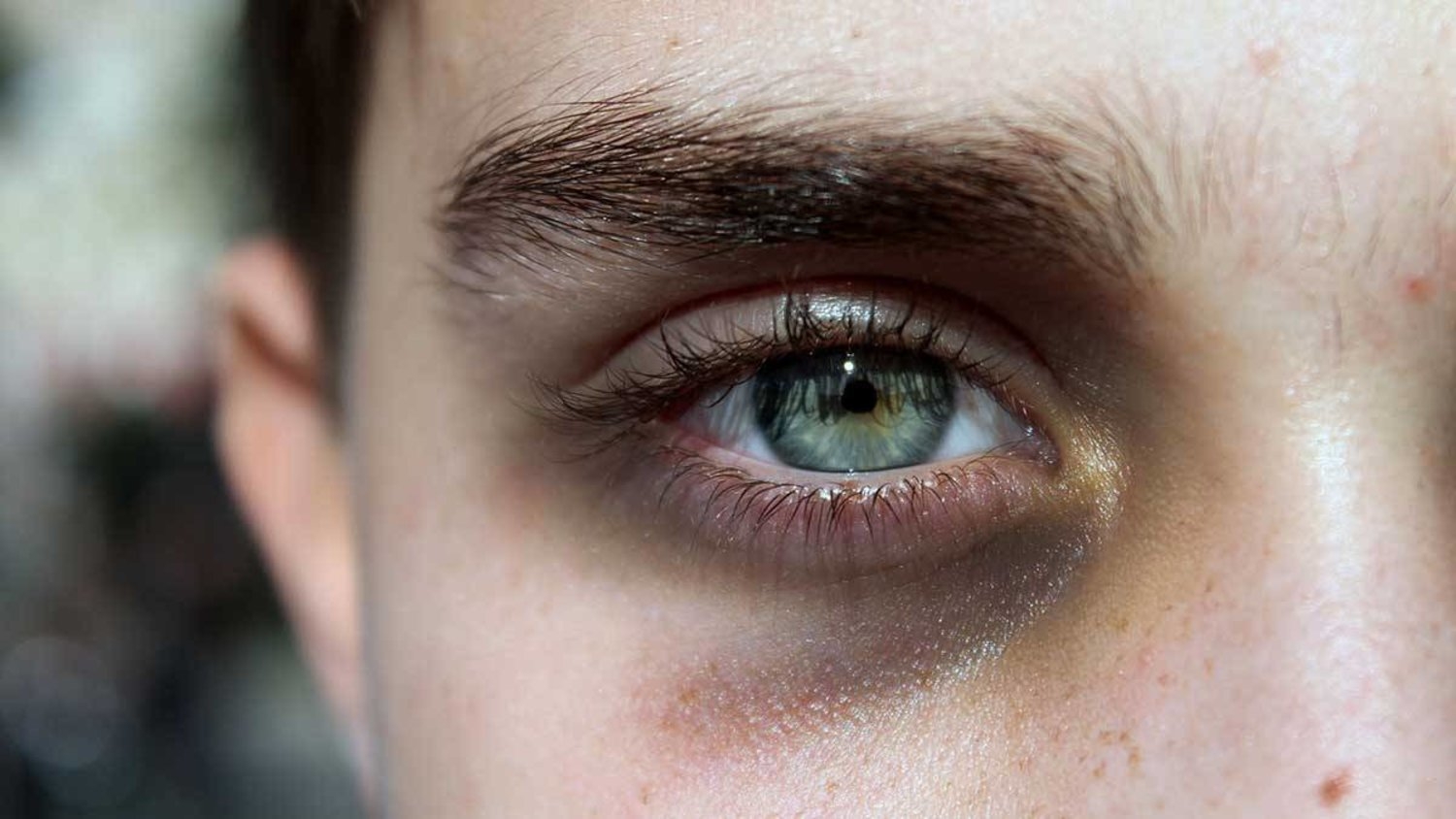 هالات أسفل العين قد تشير لأمراض خطيرة