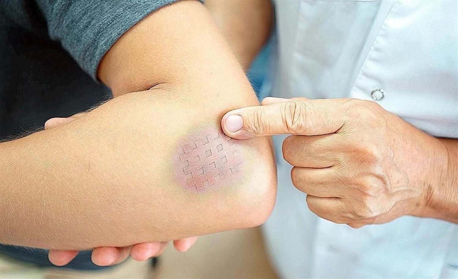 9 أسباب تسرّع إصابتك بالكدمات