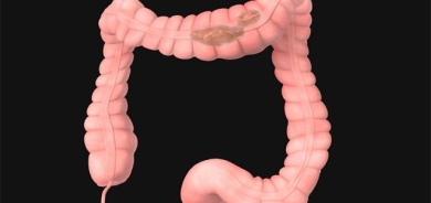 خۆراكی شیرین نیشانەكانی گرژبوونی كۆڵۆن زیاد دەكەن