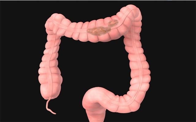 خۆراكی شیرین نیشانەكانی گرژبوونی كۆڵۆن زیاد دەكەن