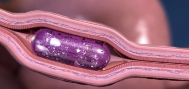 «حبة روبوتية» لعلاج هشاشة العظام