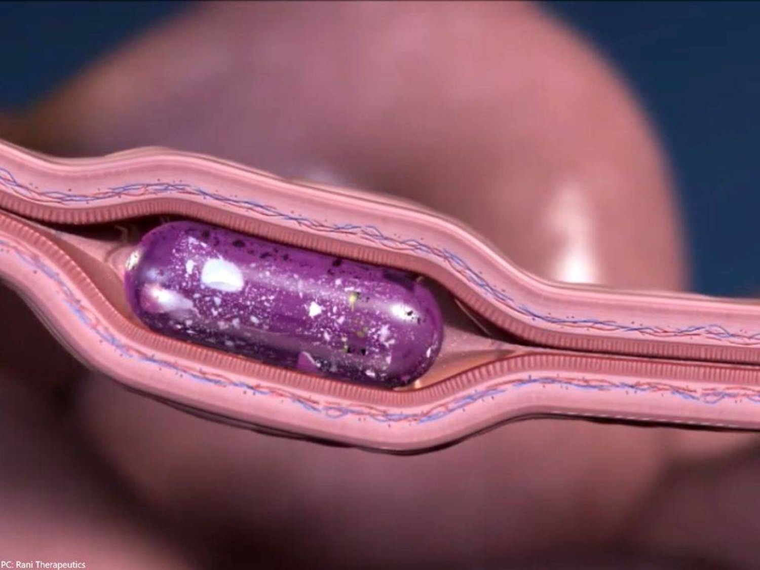 «حبة روبوتية» لعلاج هشاشة العظام