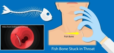 عندما تعلق شوكة سمك في الحلق... ماذا عليك أن تفعل؟