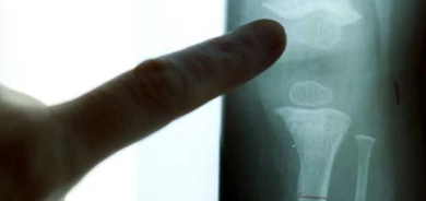 كيف يمكن أن يؤثر شكل هيكلك العظمي على صحتك؟