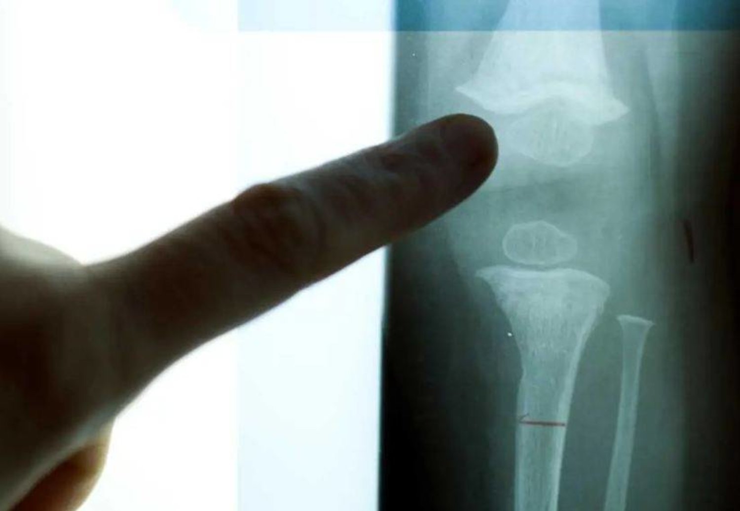 كيف يمكن أن يؤثر شكل هيكلك العظمي على صحتك؟