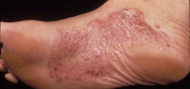 دراسة ضخمة تربط حالات الصدفية الشديدة بانخفاض فيتامين D