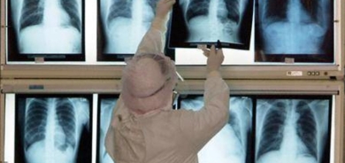 الذكاء الاصطناعي يكشف السكري مبكرا بالأشعة السينية