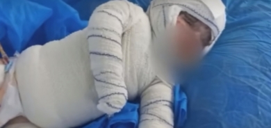 مسرور بارزاني يوجه بفعل كل ما يلزم لمعالجة طفلة احترق جسدها بـ ‹الأسيد›