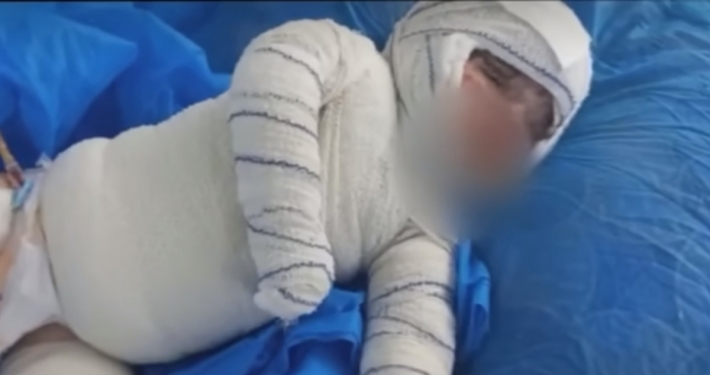 مسرور بارزاني يوجه بفعل كل ما يلزم لمعالجة طفلة احترق جسدها بـ ‹الأسيد›