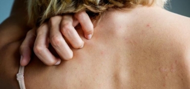 هل تعاني من بثور الظهر؟.. ابتعد عن منتجات الألبان