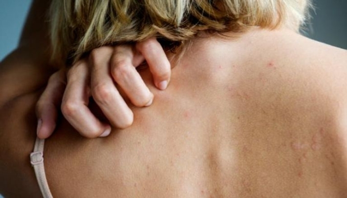 هل تعاني من بثور الظهر؟.. ابتعد عن منتجات الألبان