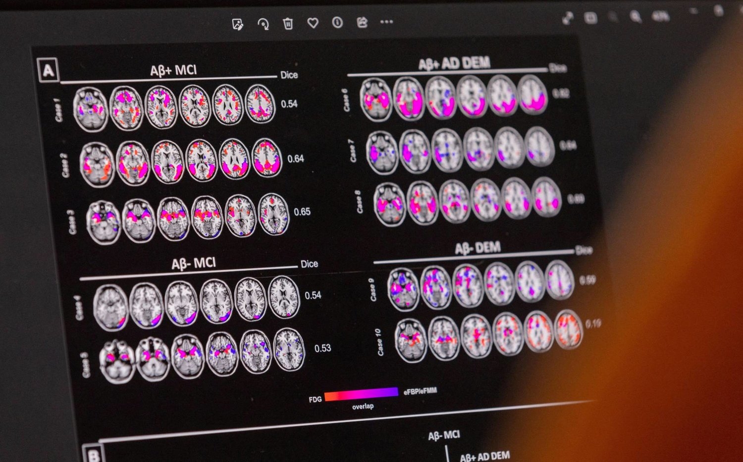 دراسة: أدمغة مرضى ألزهايمر تعاني من نقص في 5 مغذيات دقيقة