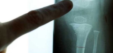 خبراء: انخفاض مستويات التستستيرون قد يؤدي لضعف العظام!