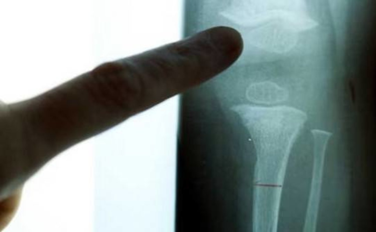 خبراء: انخفاض مستويات التستستيرون قد يؤدي لضعف العظام!