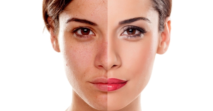 أسباب اسمرار البشرة .. ما هي طرق العلاج؟