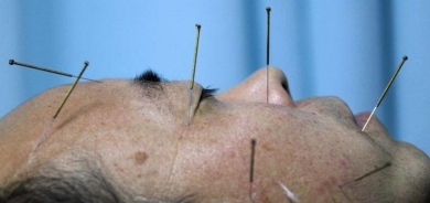 طبيبة تنفي فعالية الإبر الصينية علميا !