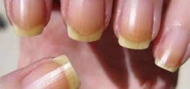 هل تشير الأظافر الصفراء لمشاكل صحية؟ طبيب يجيب