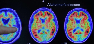 تفكيك اللغز... علماء يكتشفون كيف تموت خلايا الدماغ لدى مرضى ألزهايمر