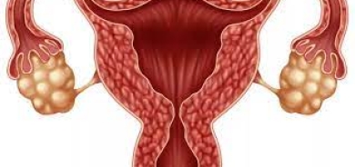 متلازمة «تكيّس المبايض» وعلاقتها بصحة الأمعاء