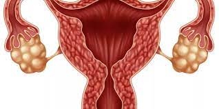متلازمة «تكيّس المبايض» وعلاقتها بصحة الأمعاء