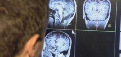 السكتة الدماغية... قد تسبب 10 ملايين حالة وفاة سنوياً بحلول عام 2050