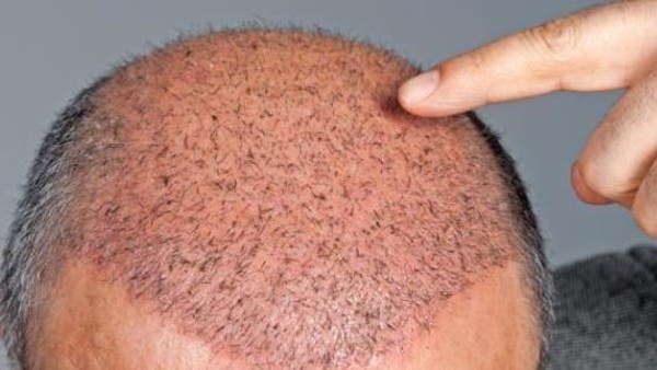 7 خرافات حول عمليات زراعة الشعر!