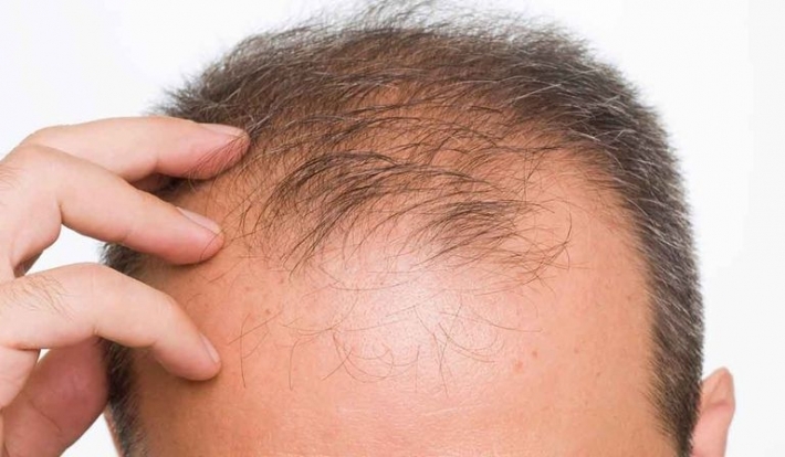 علاج الصلع.. أمل جديد في تقنية «ثلاثية الأبعاد»