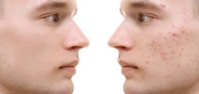 الصورة النمطية لحَب الشباب وأثرها النفسي