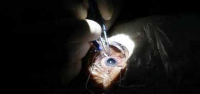 8 علامات أولية تشير للإصابة بـ«الاستجماتيزم»