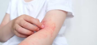 اكتشاف مسبب غير متوقع للأكزيما... وأدلة حول كيفية إيقافه