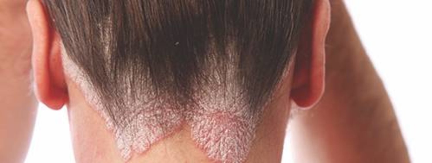 9 علاجات منزلية فعّالة للتخلص من صدفية فروة الرأس