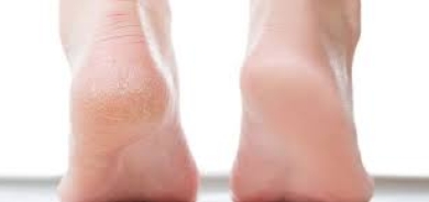 احذر شقوق الجلد والأقدام المبللة... لها صلة بأمراض القلب!