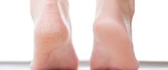 احذر شقوق الجلد والأقدام المبللة... لها صلة بأمراض القلب!