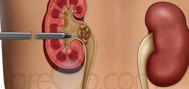 ئەو خۆراكانەی ئەگەری بەردی گورچیلە زیاد دەكەن