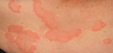 كيف تعرف أمراضك الخفية من خلال بشرتك؟!