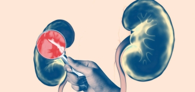 دواء جديد يمكن أن يؤخر الفشل الكلوي