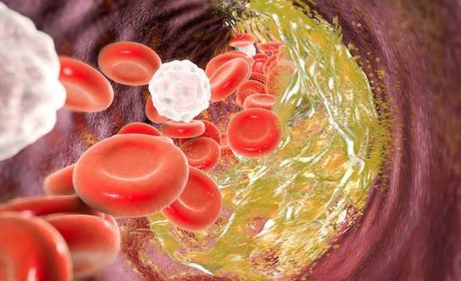 ما هو ارتفاع كوليسترول الدم الوراثي ؟