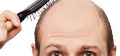 طبيبة تكشف الأطعمة التي تساعد على مكافحة الصلع