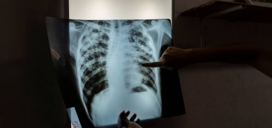 التهاب الكبد والسكري يزيدان من فرص الإصابة بالسُل النشط؟!