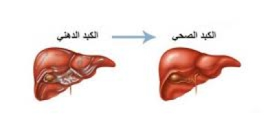 طريقة طبيعية لعكس مرض الكبد الدهني