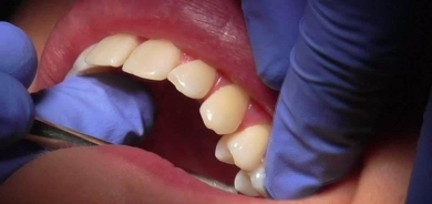 مادة في الشاي الأخضر تكافح التهاب اللثة