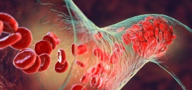 ما الرابط بين الالتهاب والكوليسترول؟