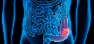 3 علامات تحذيرية لسرطان القولون بين الشباب